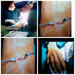 اولین عمل  جراحی مغز واعصاب  توسط دکتر وحید باوند پور متخصص  جراحی مغز واعصاب وستون فقرات  در سرپل ذهاب انجام گردید.